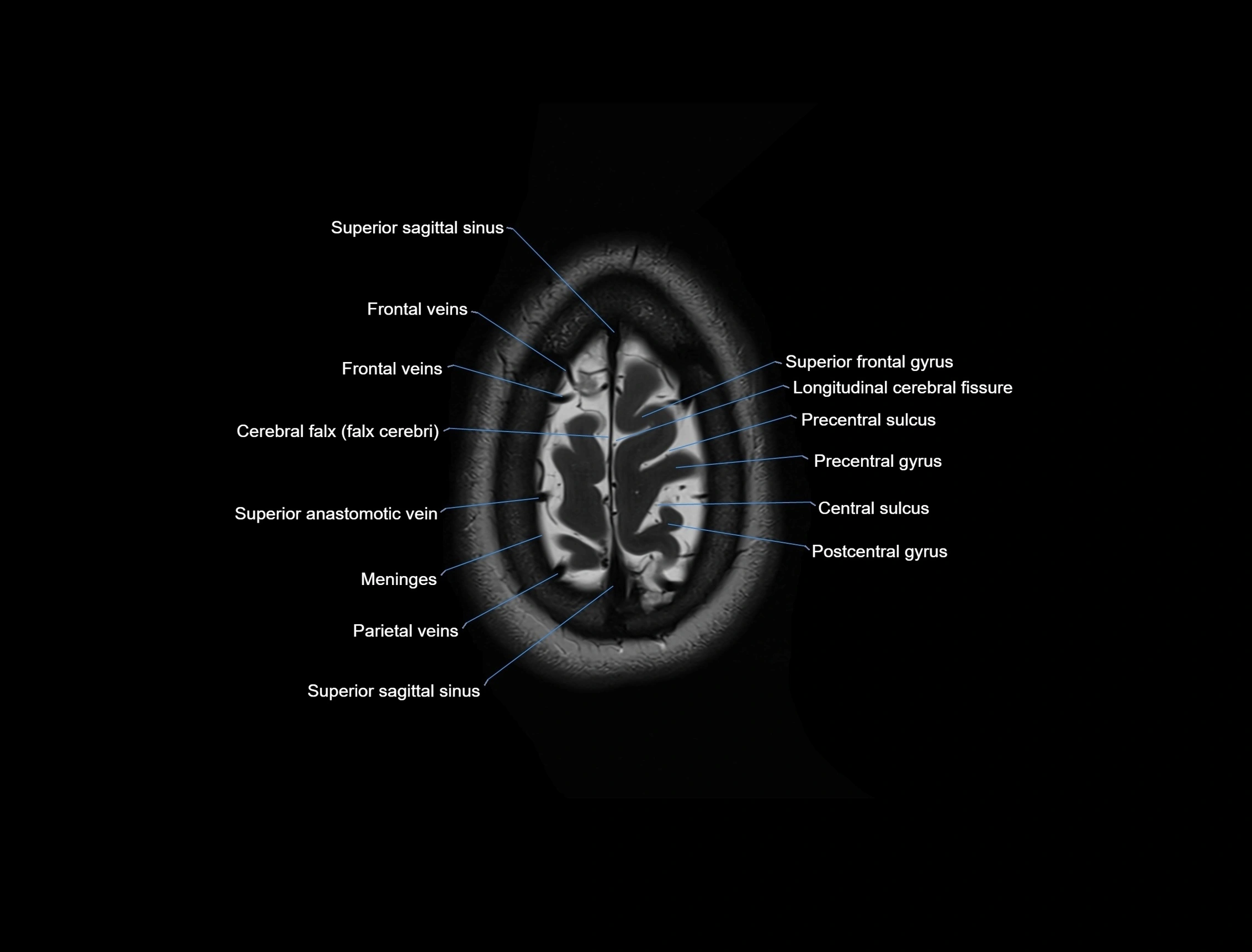 MRI Brain axial cross sectional radiology anatomy 3T image  -img-00001-00056.webp